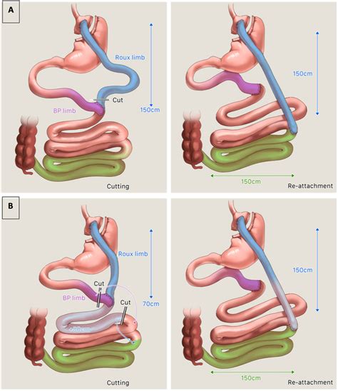 Types Of Distal Bypass Revision A One Anastomosis Technique For