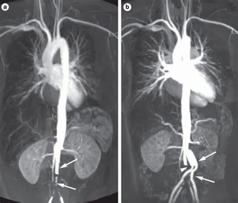 Medical Treatment Pictures-for Better Understanding: Takayasu Arteritis