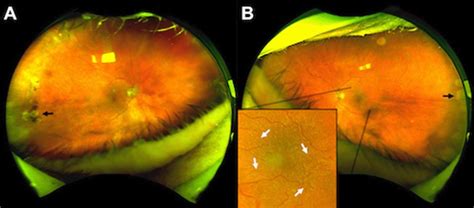 Wide-field fundus photographs of a participant with Cobblestone ...