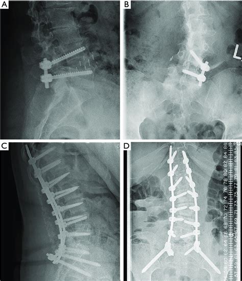 Lateral And Antero Posterior Radiographs Of A Patient With Llif