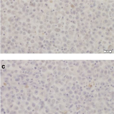 Lung Surgical Specimens A Surgical Specimens Stained With