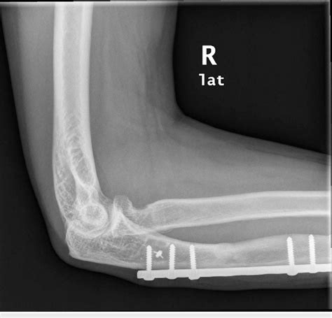 Lateral elbow radiograph two years post-annular ligament reconstruction... | Download Scientific ...