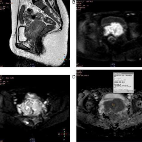 Staging Of Uterine Cervix Carcinoma According To Figo 4 Download Scientific Diagram