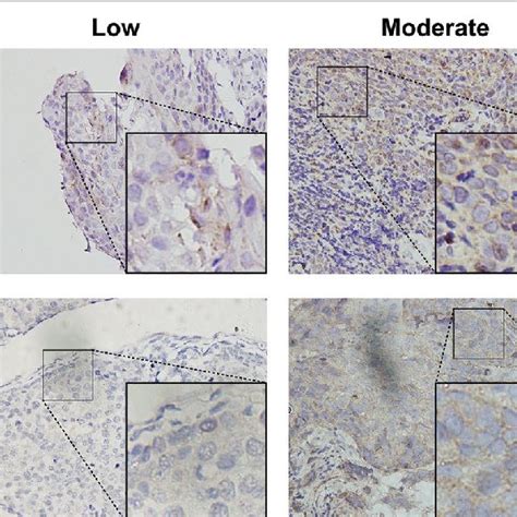 Nrf And Slc A Expression In Escc Tissues Representative Images For