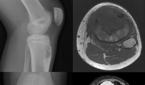 Roentgen Ray Reader: Chondromyxoid Fibroma