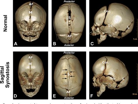 Figure 1 from Molecular basis of cranial suture biology and disease ...