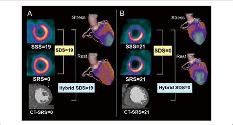 Examples Of A Stress Induced Ischemia And B Myocardial Infarction Download Scientific Diagram