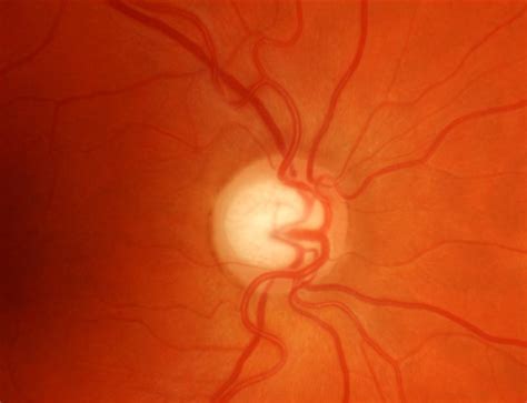 Atrofia Del Nervio óptico Por Glaucoma Cso