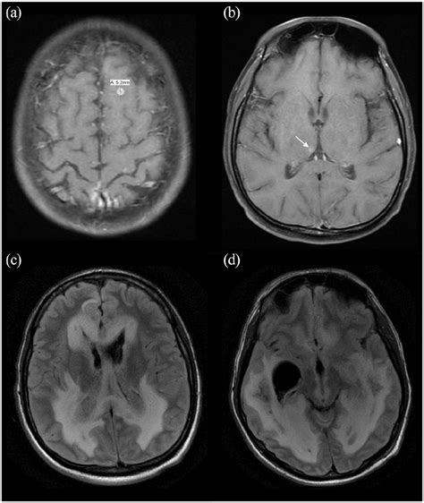 MRI brain imaging. (a) A 0.5 cm ring-enhancing lesion. Additional foci... | Download Scientific ...