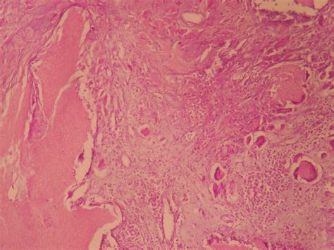 PILOMATRICOMA – Histopathology.guru