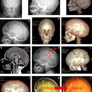 Case report 1. H-craniectomy for scaphocephaly at 3 months, frontal (A ...