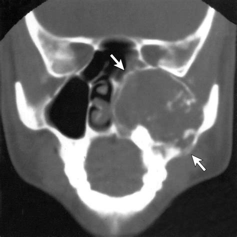 Fibrous Dysplasia Involving The Skull Base And Temporal Bone Headache