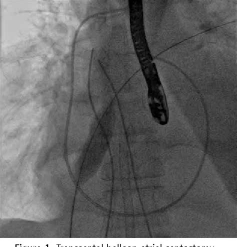 Figure 1 From Transseptal Balloon Atrial Septostomy For Decompression