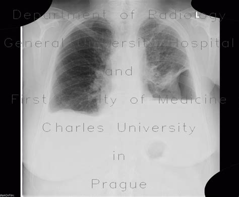 Radiology Case Hydropneumothorax