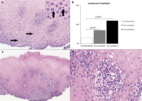 Normal esophageal squamous mucosa has scattered intraepithelial ...