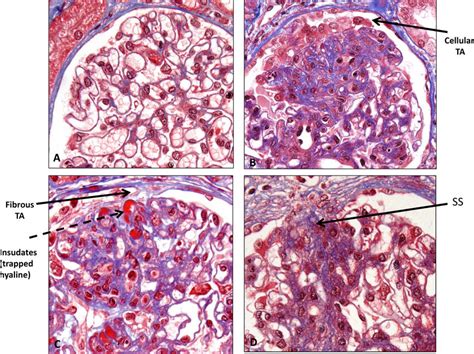 Formation Of Fsgs Lesion Light Microscopy Trichrome Stain Panel A