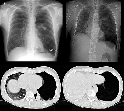 Double Wall Sign In Pneumothorax Double Bronchial Wall Sign