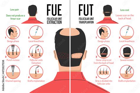 Fut And Fue Hair Transplantation Process Vector Isolated Follicular