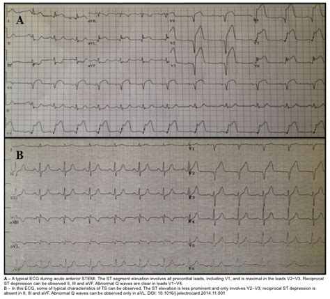 Takotsubo Syndrome A Comprehensive Review Recapem