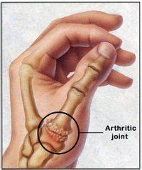 8 best Thumb Pain Relief | Treatments & Splints for Basal Joint ...