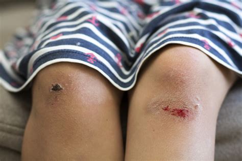 Primer plano de una niña pequeña contusión lesionada en las rodillas