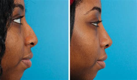 Rhinoplasty Toronto | Nose Job Cost Ontario - Dr. Asaria