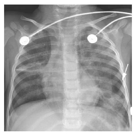 Axial View On Ct Chest The Pneumatocele Measured Approximately Cm