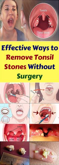 Let Start Slim Today: Effective Ways To Remove Tonsil Stones Without ...