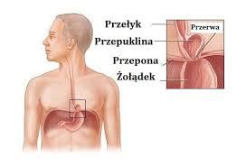 Przepuklina Rozworu Prze Ykowego Przyczyny Powstawania Objawy I