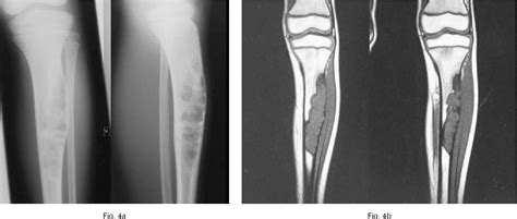 PDF Osteofibrous Dysplasia Of The Tibia Is There A Need For A