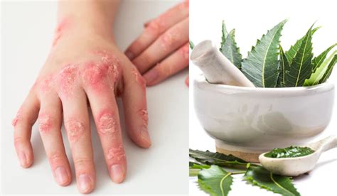 Neem Oil Home Remedies Tips Is Effective In Daad Khaj Khujli Ringworm