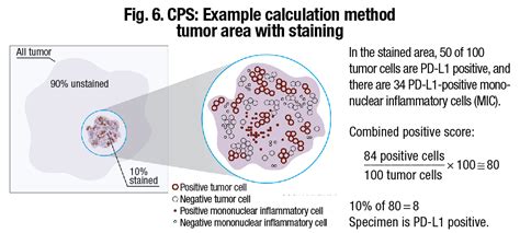 Scoring Gastric Gej Cancers For Pd L Expression Cap Today