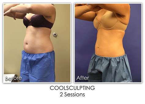 Coolsculpting Pro Archives Page 2 Of 3 Skin Rejuvenation Clinic