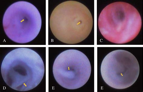 Diagnosis And Treatment Of Radioactive Iodine‐induced Sialadenitis A