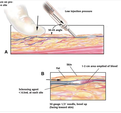 Figure 1 from Aesthetic treatment of leg veins. | Semantic Scholar