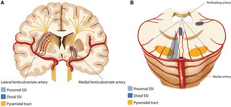 Lenticulostriate Arteries Stroke