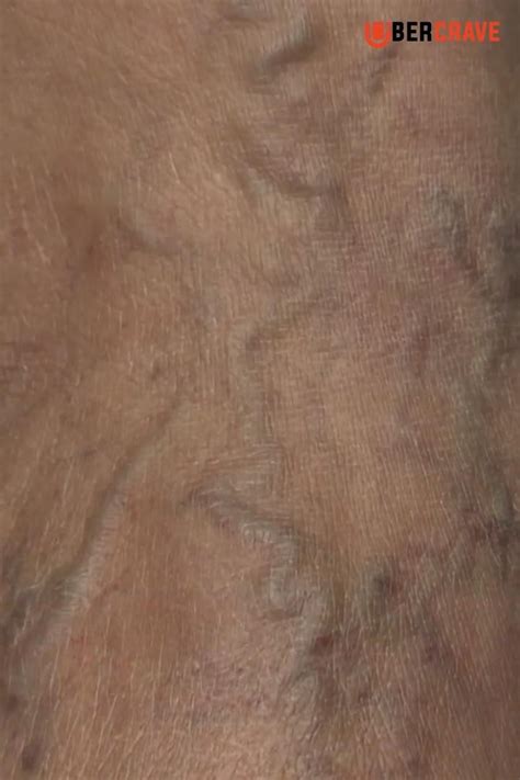 2 Step Spider Vein Treatment Artofit