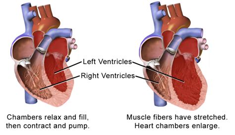 Broken Heart Syndrome - Manhattan Cardiology