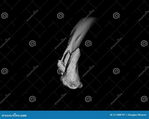 Rx Image of Left Clavicle Fracture Stock Image - Image of exam, injury ...