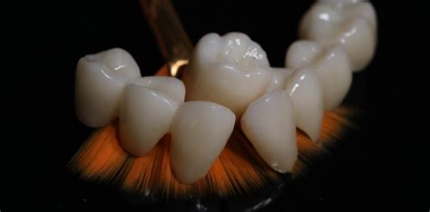 Coronas de Zirconio - Zirconia®