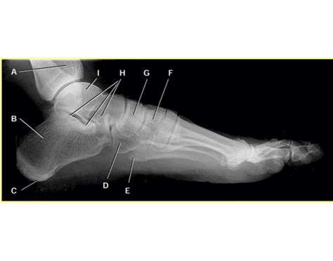 foot x-ray anatomy Quiz