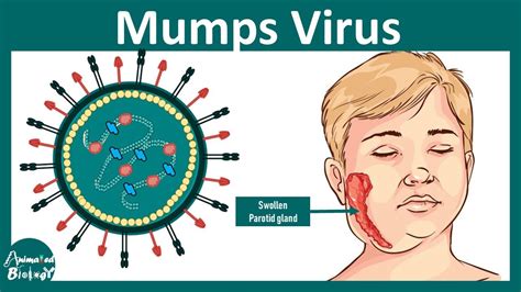 Mumps Mumps Virus Pathology Diagnosis And Treatment Youtube