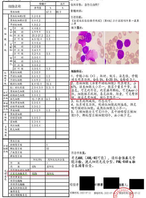 治疗相关免疫分型不典型急性早幼粒细胞白血病1例 医学界 助力医生临床决策和职业成长