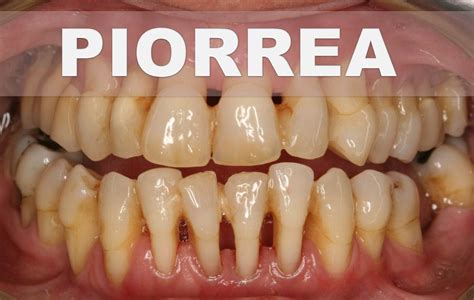 Remedios Caseros Para La Periodontitis O Piorrea Como Tratar La