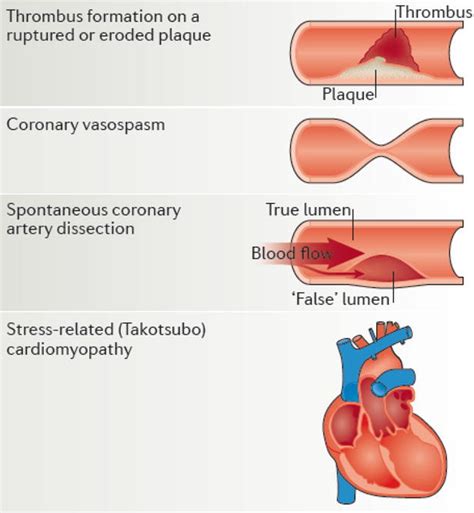 Sex Differences In Cardiovascular Disease Impact On Care And Outcomes