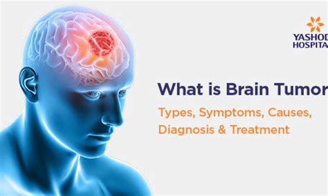 Understanding Brain Tumors Types Symptoms And Treatments By Aleem