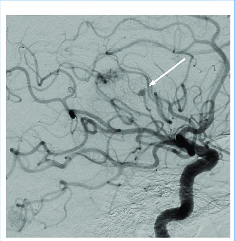 Lateral Cerebral Angiogram With Right Sided Internal Carotid Artery