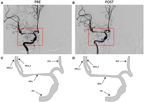 Frontiers Digital Subtraction Angiography Contrast Material Transport