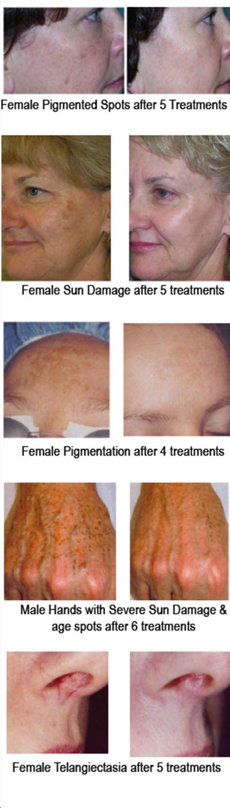 Ipl Skin Rejuvenation Bodysense Solutions