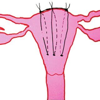 A Planned Peripartum Hysterectomy For Placenta Accreta Spectrum PAS